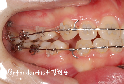 강남 돌출 관련 이미지 26