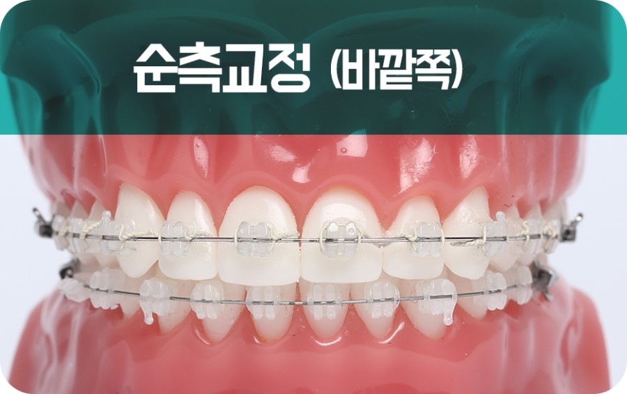 교정장치 구분하기 관련 이미지 14