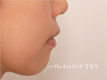 강남 돌출입 교정 관련 이미지 24