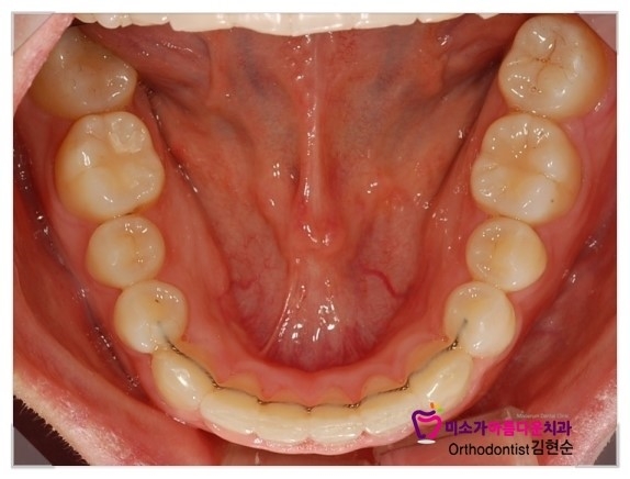 과개교합 교정 후기 세라믹교정치과 관련 이미지 5