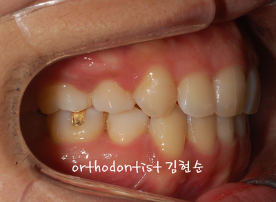 강남 돌출 관련 이미지 26