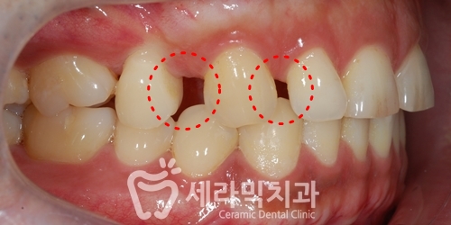 벌어진치아 투명교정 치아교정전후 관련 이미지 3