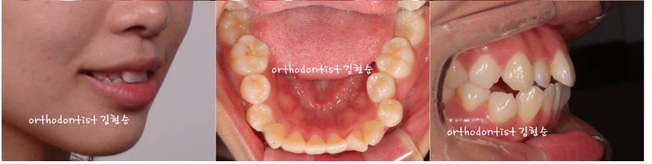세라믹교정 은 세라믹치과 수술없이 돌출개선 관련 이미지 3
