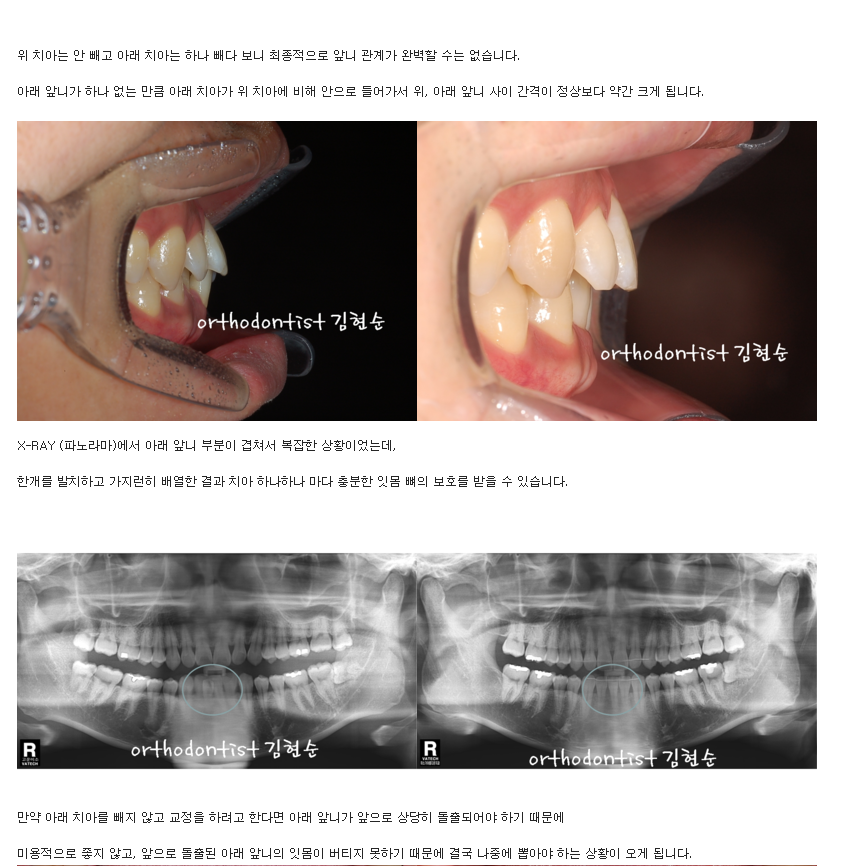 들쑥날쑥한 아래 앞니, 발치 후 교정 관련 이미지 5