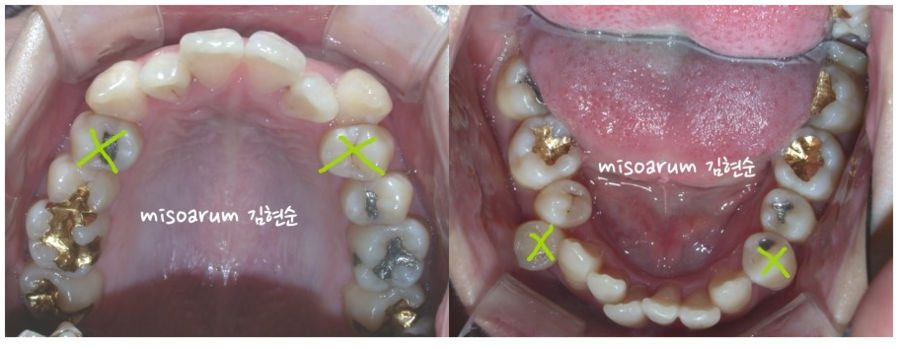 세라믹교정 덧니교정 관련 이미지 5