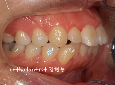 강남 돌출 관련 이미지 16