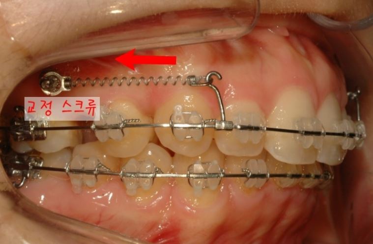 세라믹치과 수술없이 돌줄입교정 관련 이미지 7