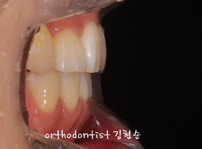 강남 덧니 관련 이미지 21