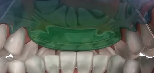 과개교합 ABP 교정 관련 이미지 5