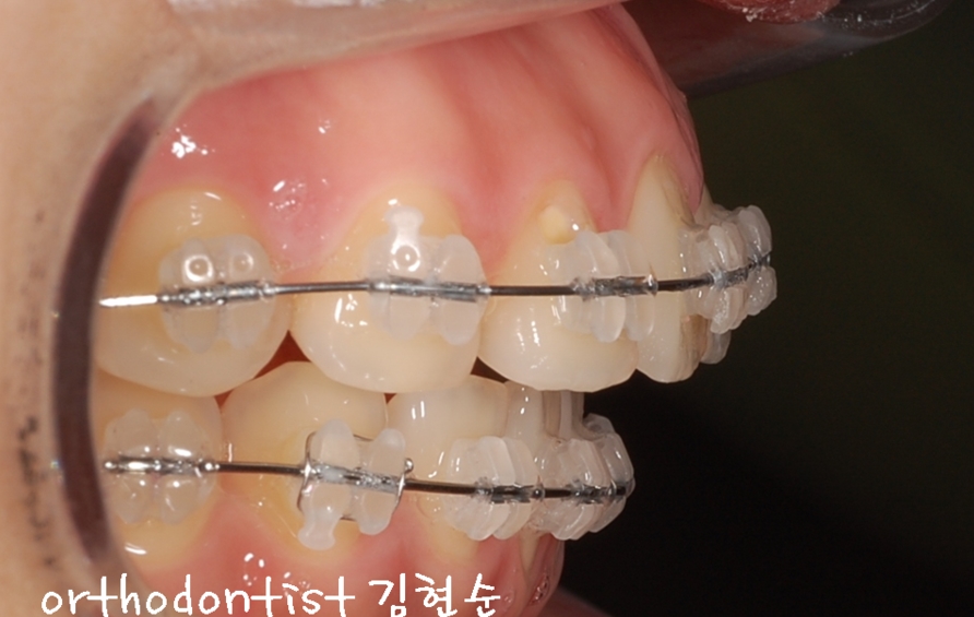 세라믹교정 은 세라믹치과 돌출입교정 관련 이미지 8