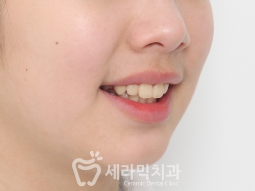 돌출입교정, 심미성과 치아 건강을 동시에 해결! 관련 이미지 10