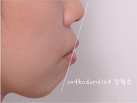 강남 돌출입 교정 관련 이미지 23