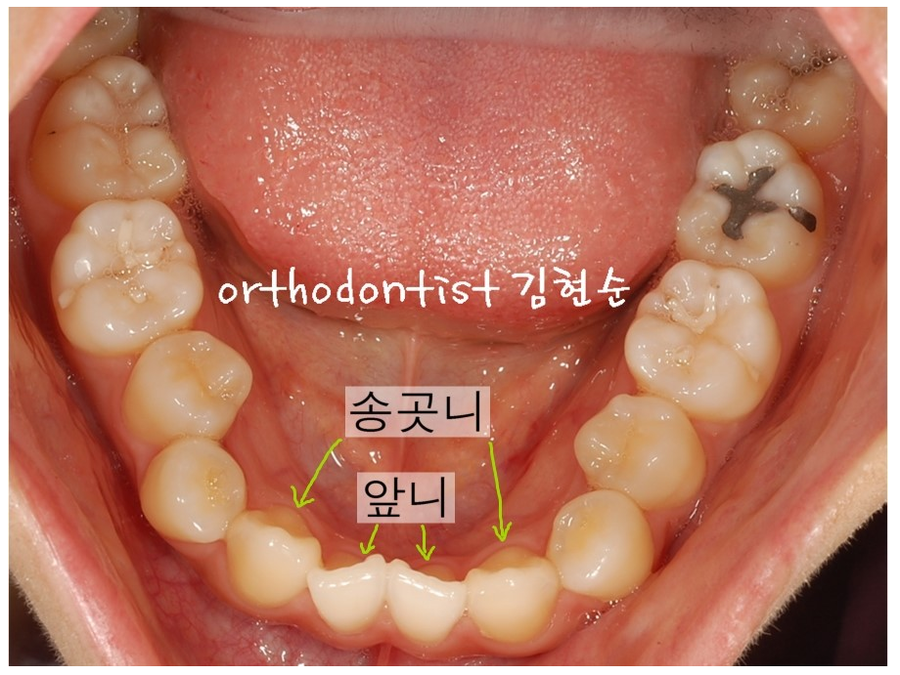 개방교합 비발치 세라믹교정 관련 이미지 5
