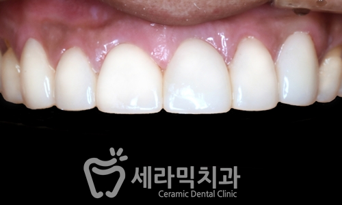 치아교정과 라미네이트는 선택이 아닌 상호 보완관계! 관련 이미지 8
