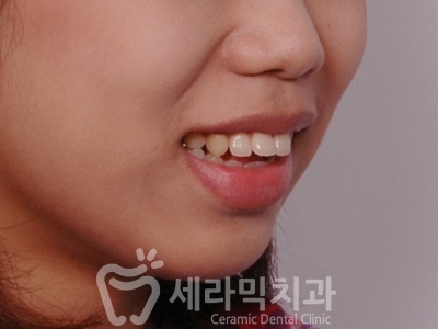 돌출입과 개방교합 치아교정 치료전후 관련 이미지 6