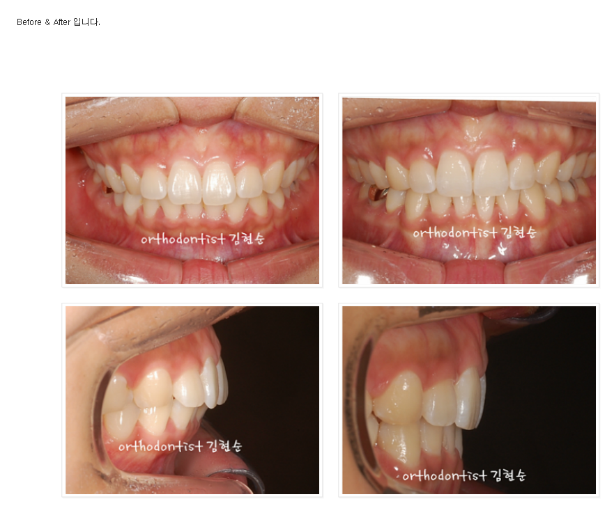 세라믹교정 세라믹치과-돌출입발치교정 7 관련 이미지 7