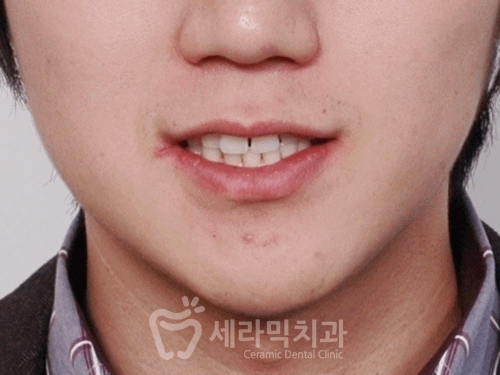 20대 남자 앞니벌어짐 개선사례, 성인 치아교정전후 달라진 Smile~ 관련 이미지 6