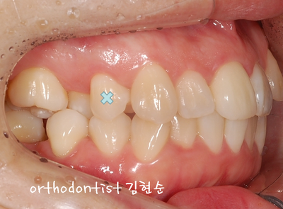 강남 덧니, 돌출 관련 이미지 16