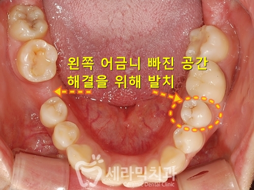 깨진 후에 후회하는 돌출입, 치아교정으로 건강하고 가지런한 치아만들기 관련 이미지 7