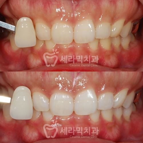 연말 치아미백 이벤트 , 학동역 세라믹치과 관련 이미지 5
