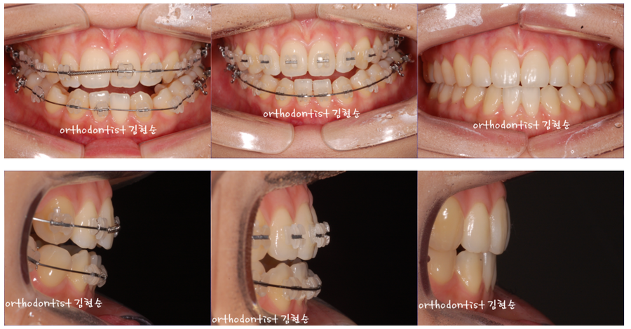 개방교합 비발치 세라믹교정 관련 이미지 9