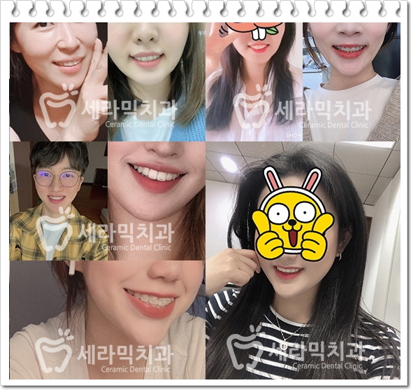 과개교합, 딥바이트 비발치 치아교정전후 관련 이미지 8