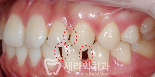 벌어진치아 세라믹교정 치아교정전후 세라믹치과 관련 이미지 3
