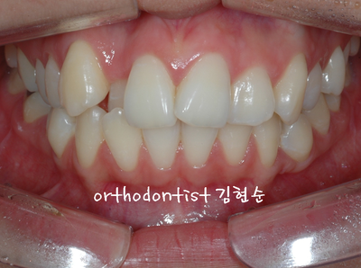 강남 돌출 관련 이미지 4