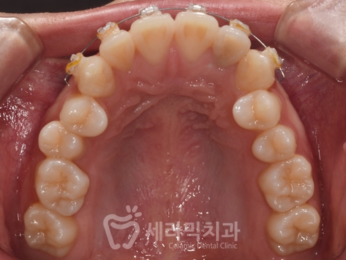 Before and After Orthodontic Treatment for Protruding Mouth and Deep Bite: A Calmer, More Sophisticated Transformation! image 6