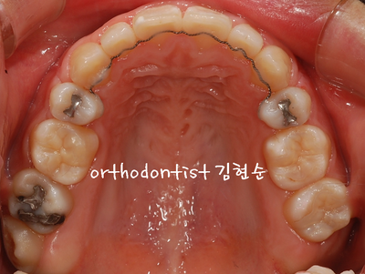 강남 돌출 관련 이미지 28