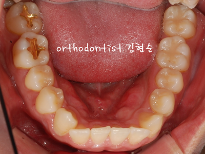 반대교합 관련 이미지 6