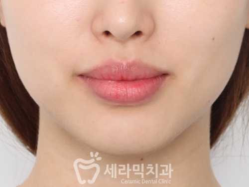 치아교정전후. 돌출입교정으로 갸름한 입술을 얻다! 관련 이미지 2