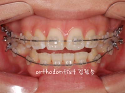 강남치아교정추천 관련 이미지 14