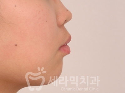 돌출입치아교정 전후사진(발치교정, 토끼이빨 인상변화) 관련 이미지 5