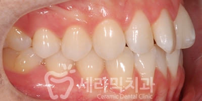 앞니 돌출, 나비치아를 남몰래 해결한 치아교정 전후! 관련 이미지 8