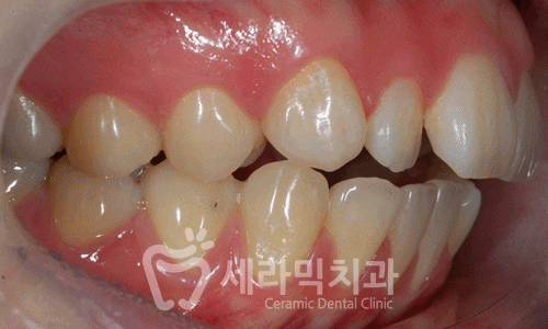 앞니 돌출, 개방교합으로 치아교정을 시작했는데, 작았던 아래턱이 커졌어요! 관련 이미지 15