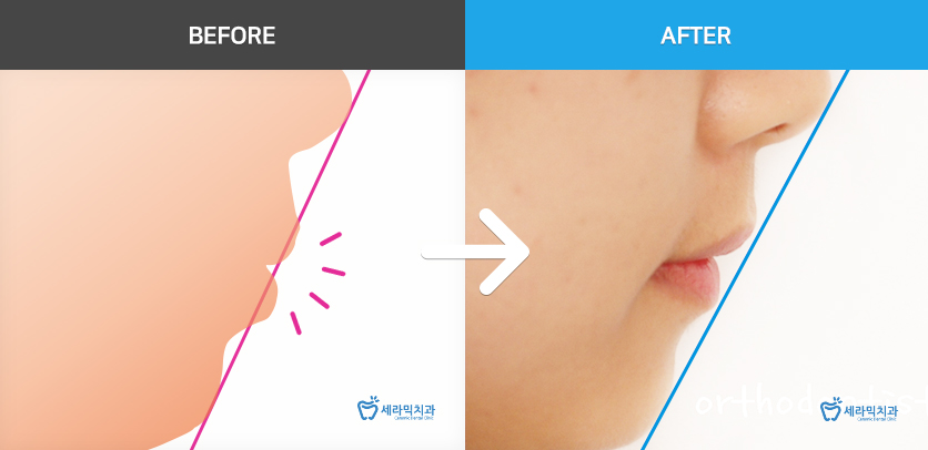 학동역치과 미국3M교정 추천 ~~ 관련 이미지 11