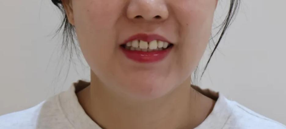 재교정에도 안 없어진 블랙 트라이앵글 치료, 라미네이트로 해결한 케이스 관련 이미지 2