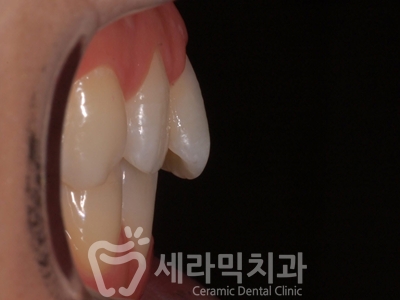 앞니 돌출, 나비치아를 남몰래 해결한 치아교정 전후! 관련 이미지 11