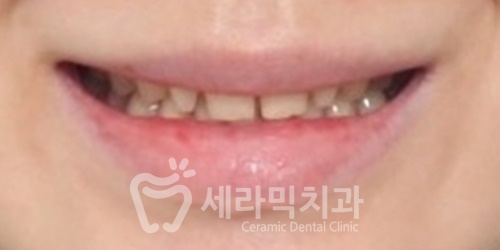 벌어진 앞니, 최소삭제 라미네이트 전후 관련 이미지 2