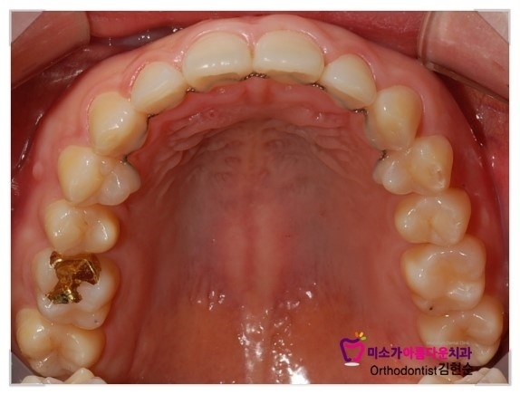 과개교합 교정 후기 세라믹교정치과 관련 이미지 4