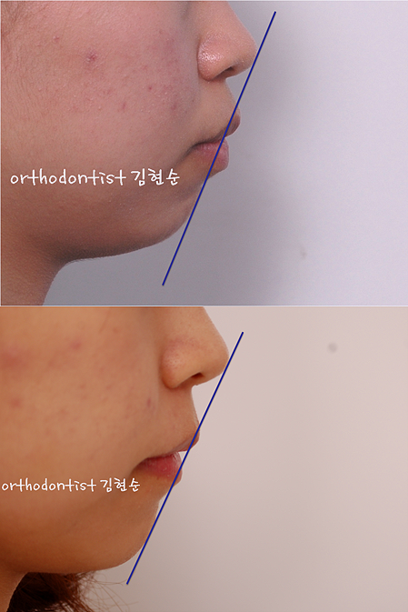 강남 돌출입 교정 관련 이미지 40