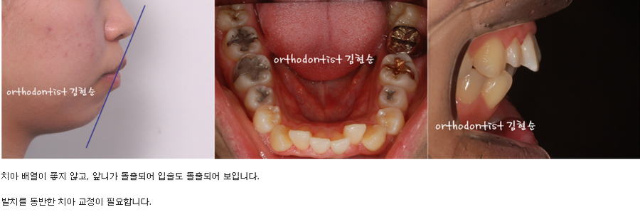 세라믹교정 세라믹치과-돌출입발치교정 5 관련 이미지 2