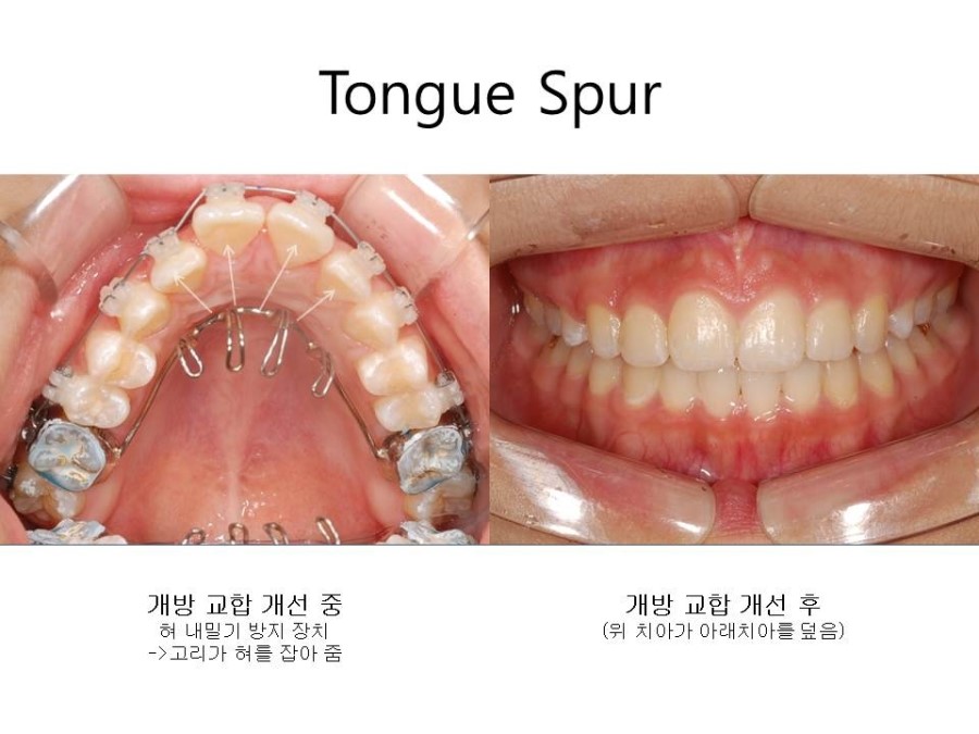 학동역치과 치아교정 잘하는 곳 ! 관련 이미지 22
