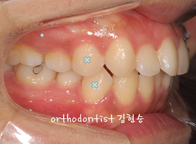 강남 돌출 관련 이미지 14