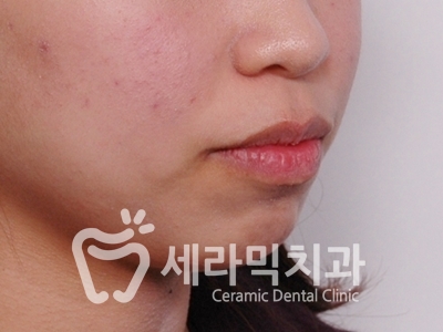 돌출입 잇몸노출 치아교정 전후 인상변화 사례 관련 이미지 6
