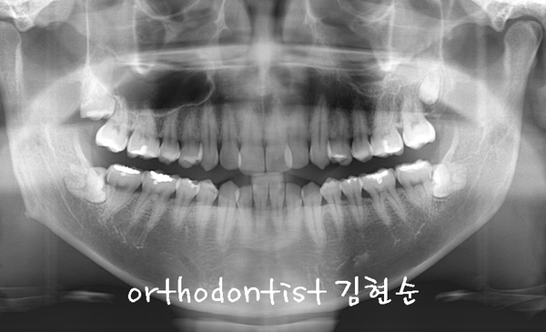 반대교합 관련 이미지 11
