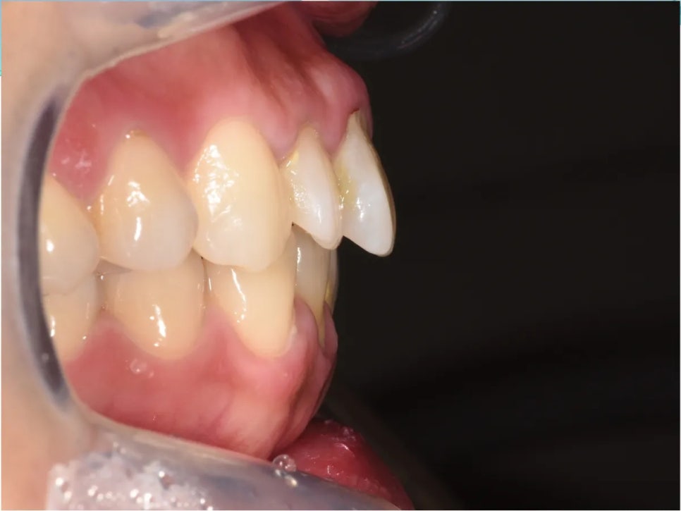 돌출입 교정 전후, 그런데 과개교합까지 있으셨던 환자분 관련 이미지 8