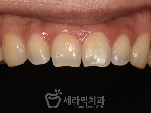 강남라미네이트치과 세라네이트 전후 사례 - 달라진 스마일라인 관련 이미지 3