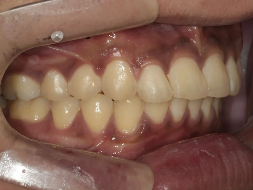 20대 남성의 토끼이빨 교정 – 소구치 발치 없이 관련 이미지 10
